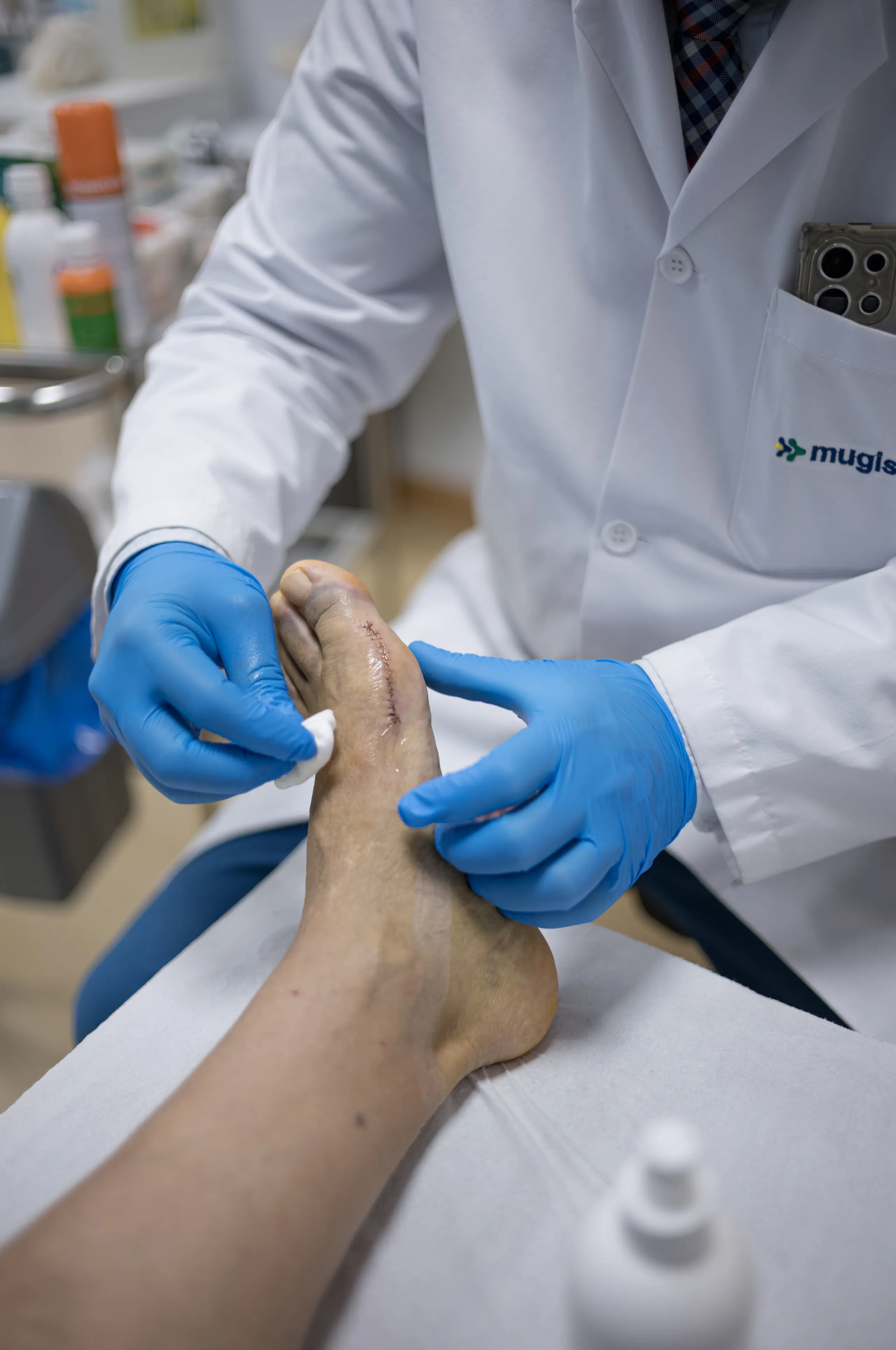 Hallux valgus severo (Scarf)