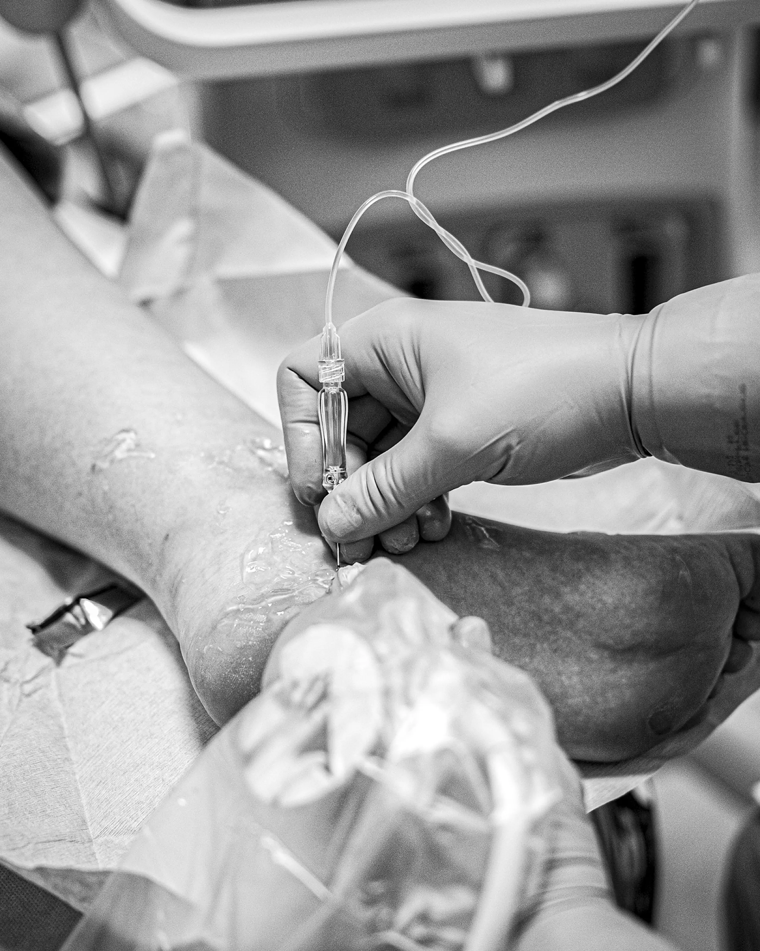 Cualquier procedimiento anterior + alargamiento gastrocnemio medial
