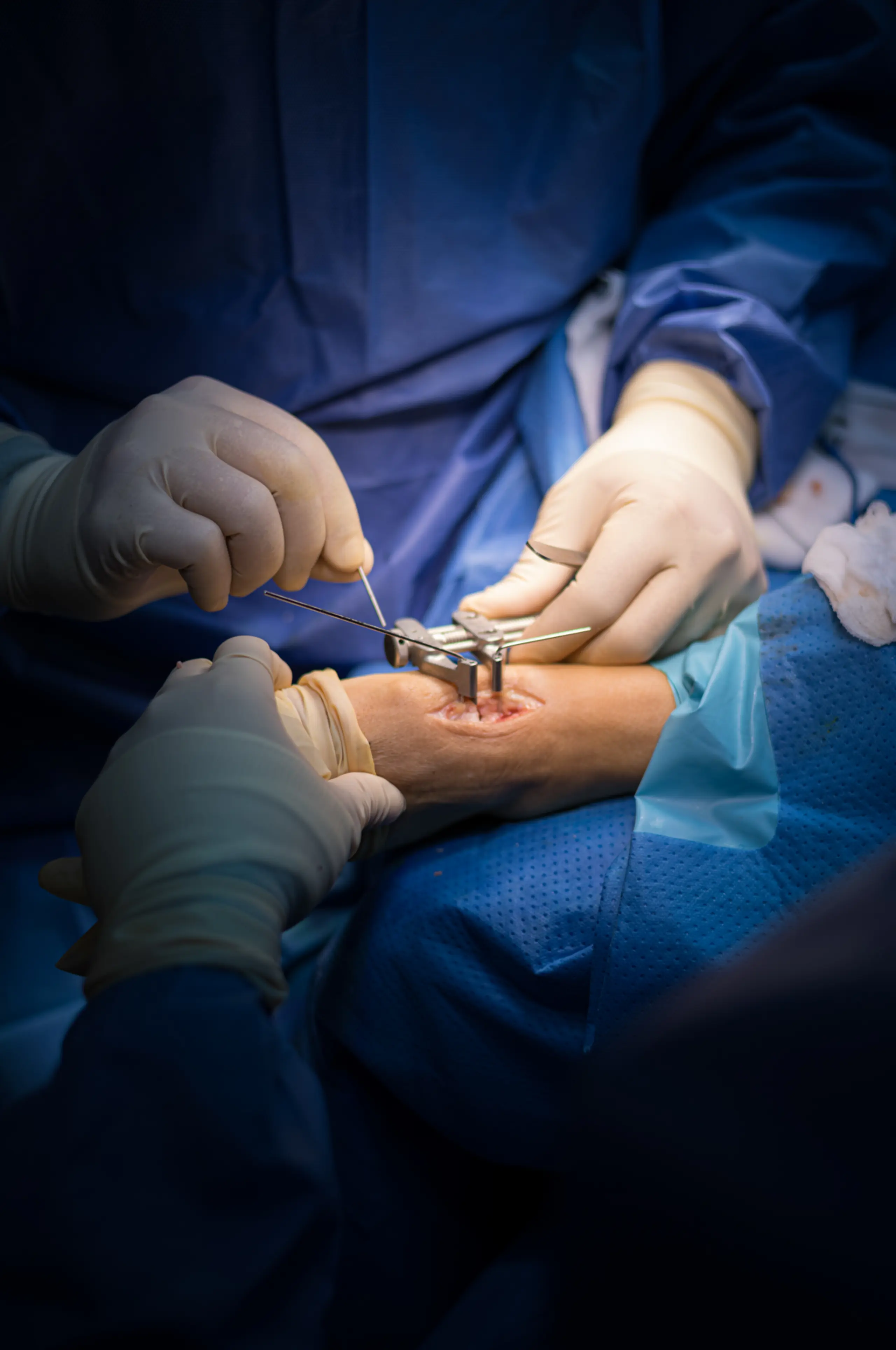 Calcaneoplastia por artroscopia