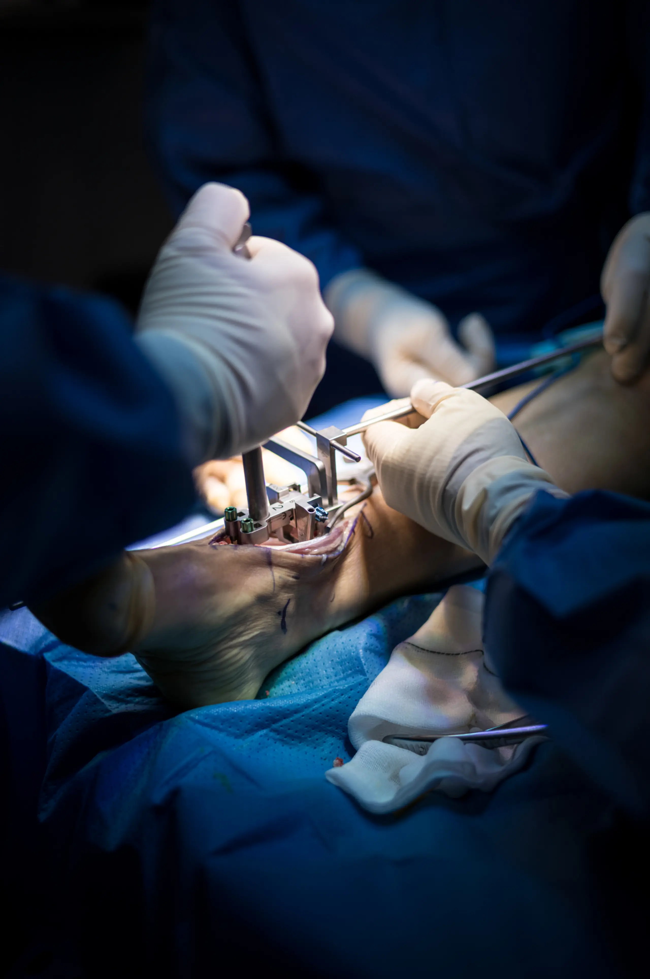 Paso 10: Implantación Componente Tibial Definitivo