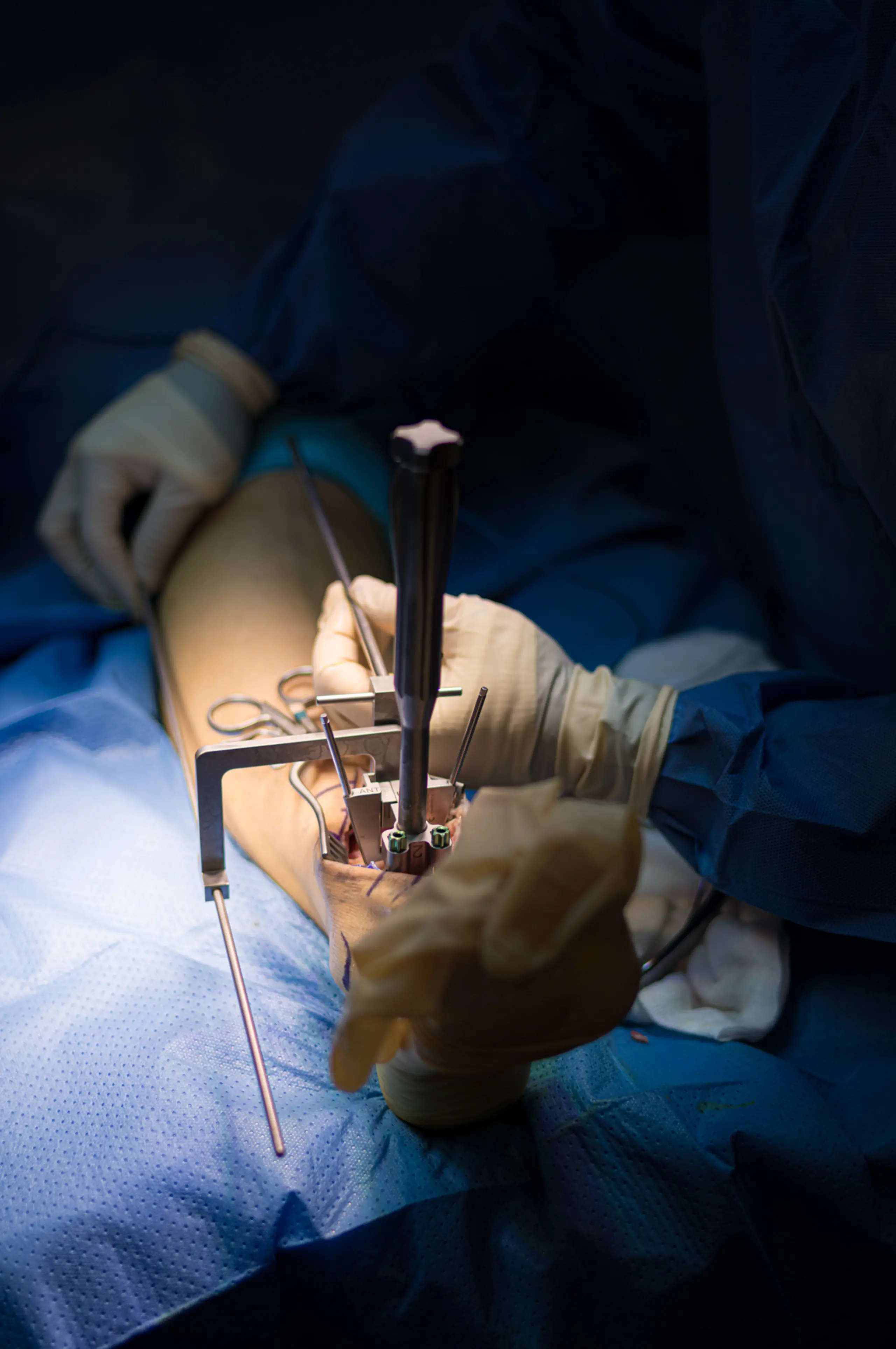 Reemplazo Articular para Artrosis Terminal