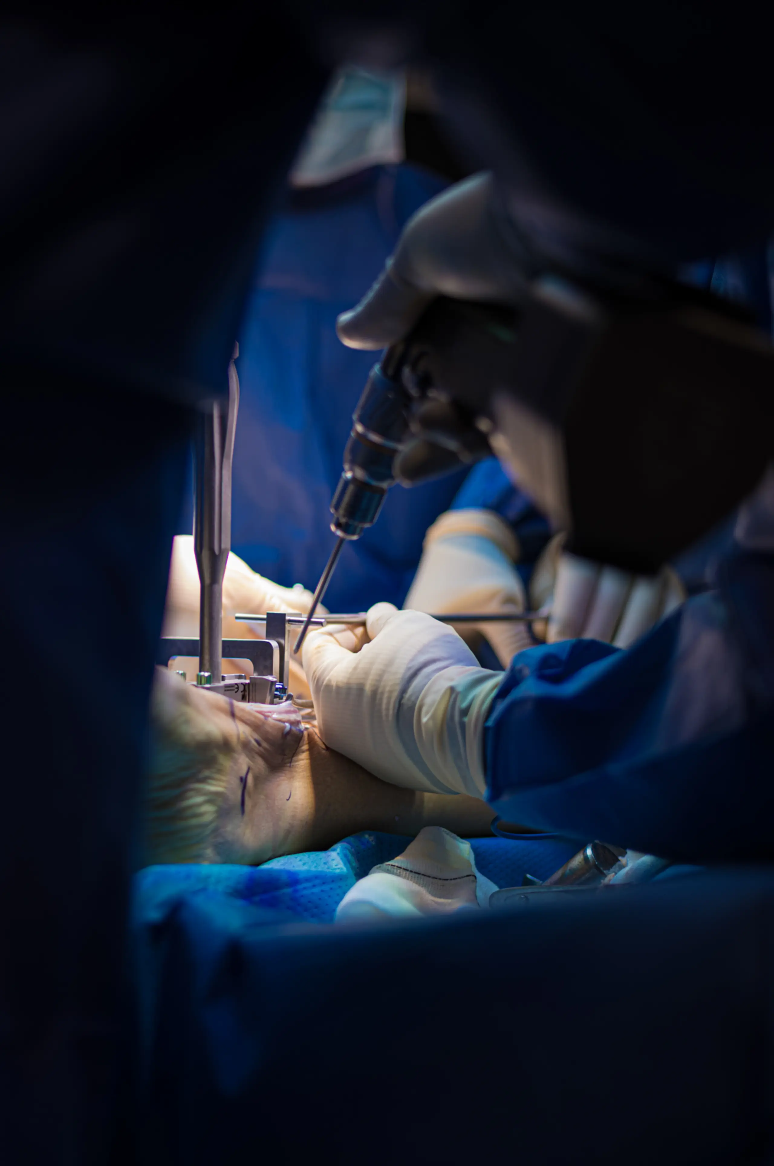 Reemplazo Articular para Artrosis Terminal